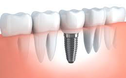 implants-image